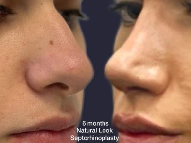 "Natural-looking septorhinoplasty results performed in Marbella, Spain."