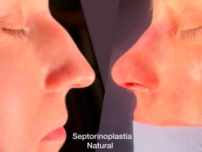 Result of a natural septorhinoplasty performed in Marbella - Spain.