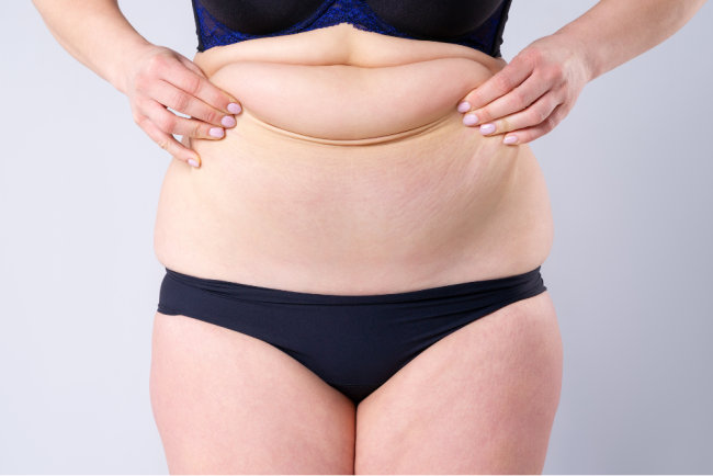 "Resultado de una liposucción abdominal en Marbella - España."