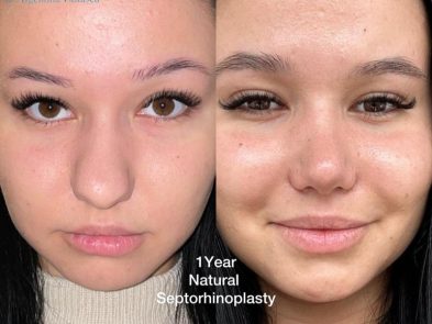 Results of a natural septorhinoplasty performed in Marbella, Spain, one year after the procedure.