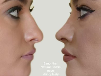 Natural rhinoplasty results in Marbella, Spain, six months after the procedure.