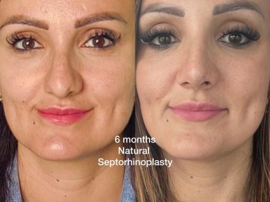 "Results of a natural septorhinoplasty after 6 months in Marbella, Spain."