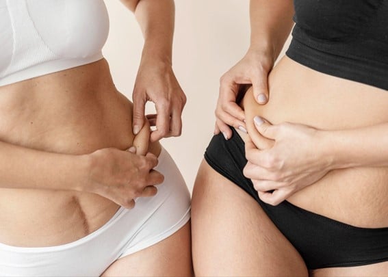 Resultado de una liposucción abdominal en Marbella - España.