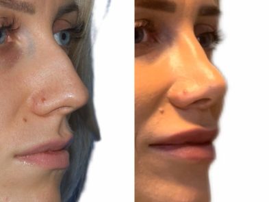 Rhinoplasty results in Marbella - Spain.
