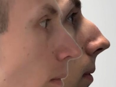 Before and after rhinoplasty in Marbella, Spain.