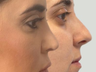 Before and after rhinoplasty performed in Marbella, Spain.