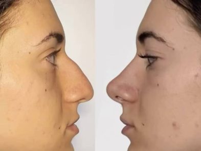 “Before and after rhinoplasty at Cirumed Clinic, Marbella, Spain.”