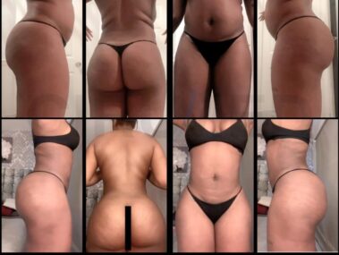 "Liposuction and buttock augmentation results in Marbella, Spain."
