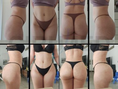 Before and after buttock augmentation in Marbella, Spain.