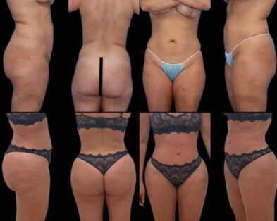Results of a buttock augmentation performed in Marbella, Spain.