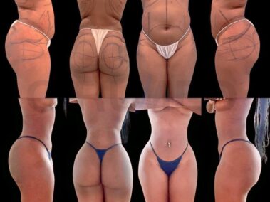 Result of a buttock augmentation performed in Marbella - Spain.
