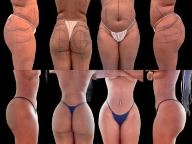 Result of a buttock augmentation performed in Marbella - Spain.