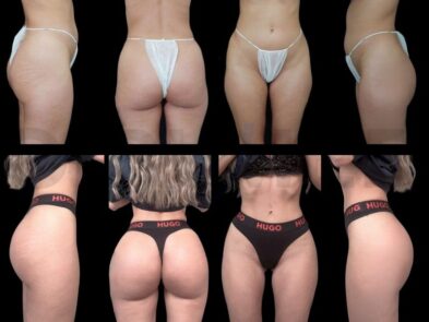 Buttock augmentation results performed in Marbella, Spain.