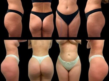 Results of a buttock augmentation performed in Marbella, Spain.