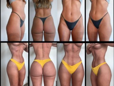 Liposuction and buttock augmentation results in Marbella, Spain.