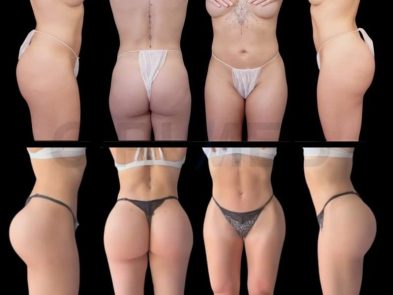 Before and after results of a supercharged BBL in Marbella, Spain