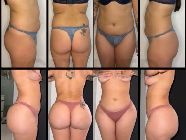 Result of a buttock augmentation performed in Marbella - Spain.