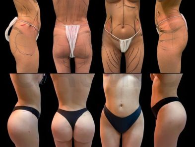 Results of buttock augmentation surgery in Marbella, Spain.