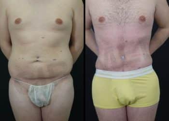 Resultados de liposucción abdominal en hombre en Marbella - España.