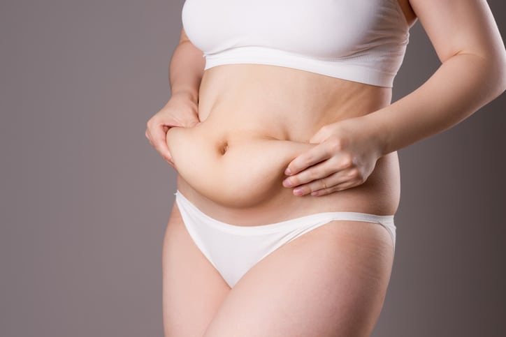 Result of abdominal liposuction in Marbella - Spain.