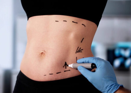 Marking prior to abdominal liposuction at Cirumed Clinic, Marbella - Spain.