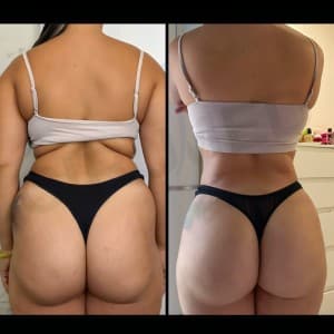 Increasing of buttocks