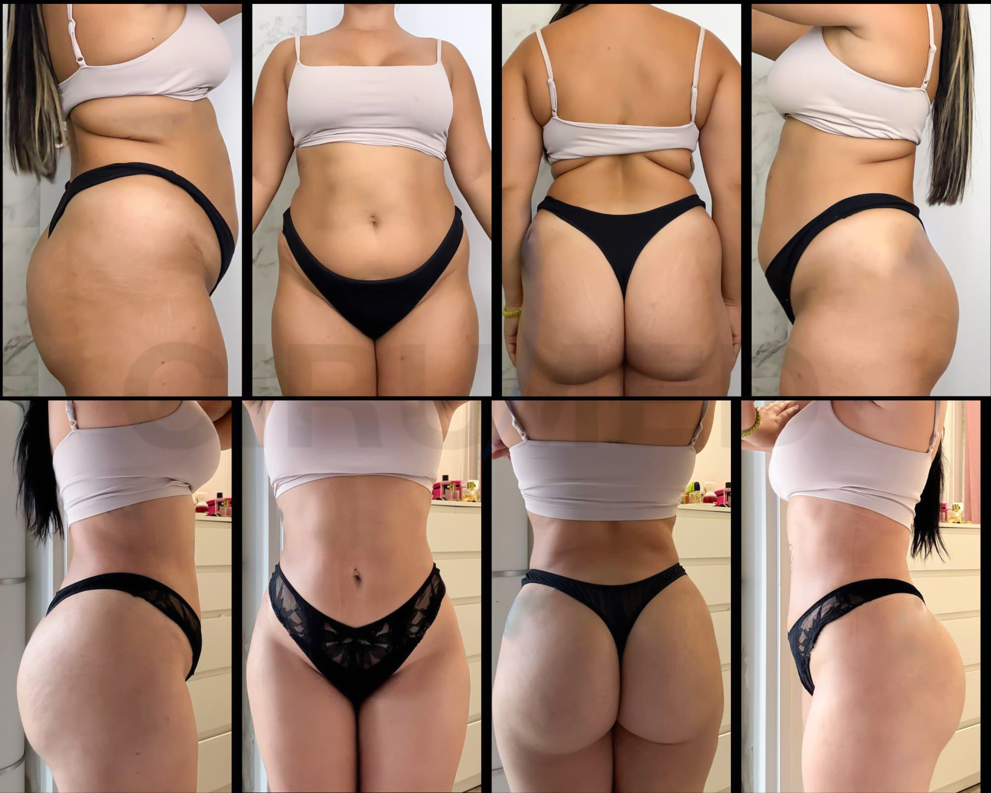 Brazilian Butt Lift resultado permanente documentado — Dr. Aslani Cirumed Marbella