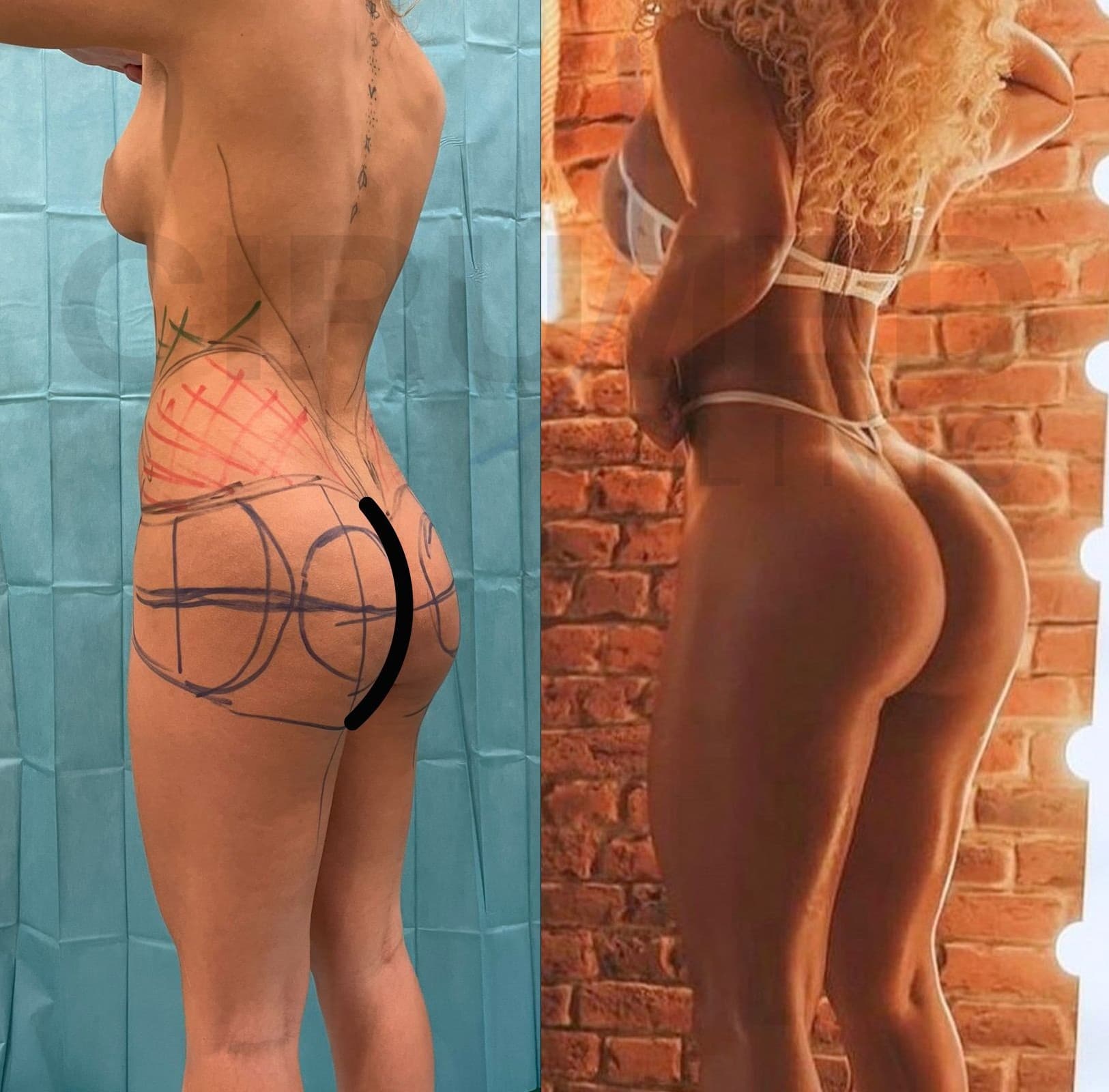 Aumento y mejora de glúteos con implantes — Cirumed Clinic Marbella