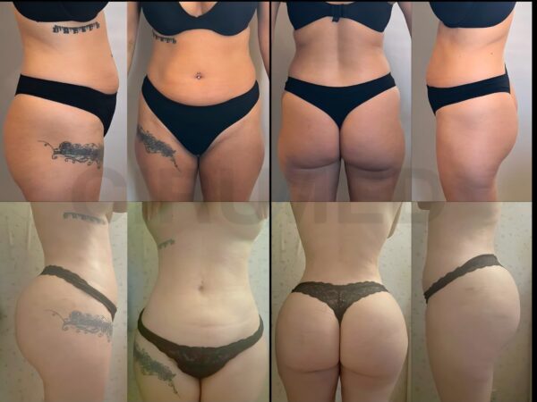 Double Brazilian butt lift stable long term result