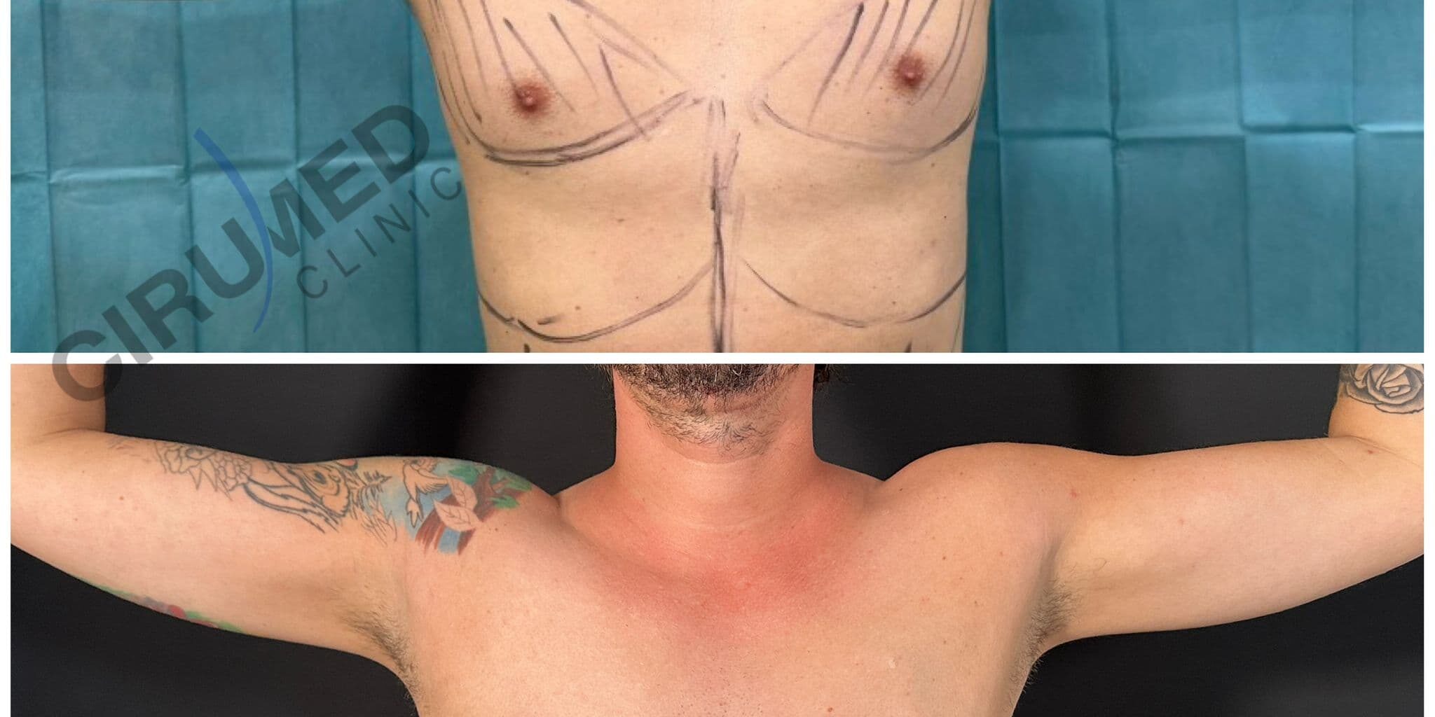Ginecomastia (_Male boobs_) corrected minimally invasive technique