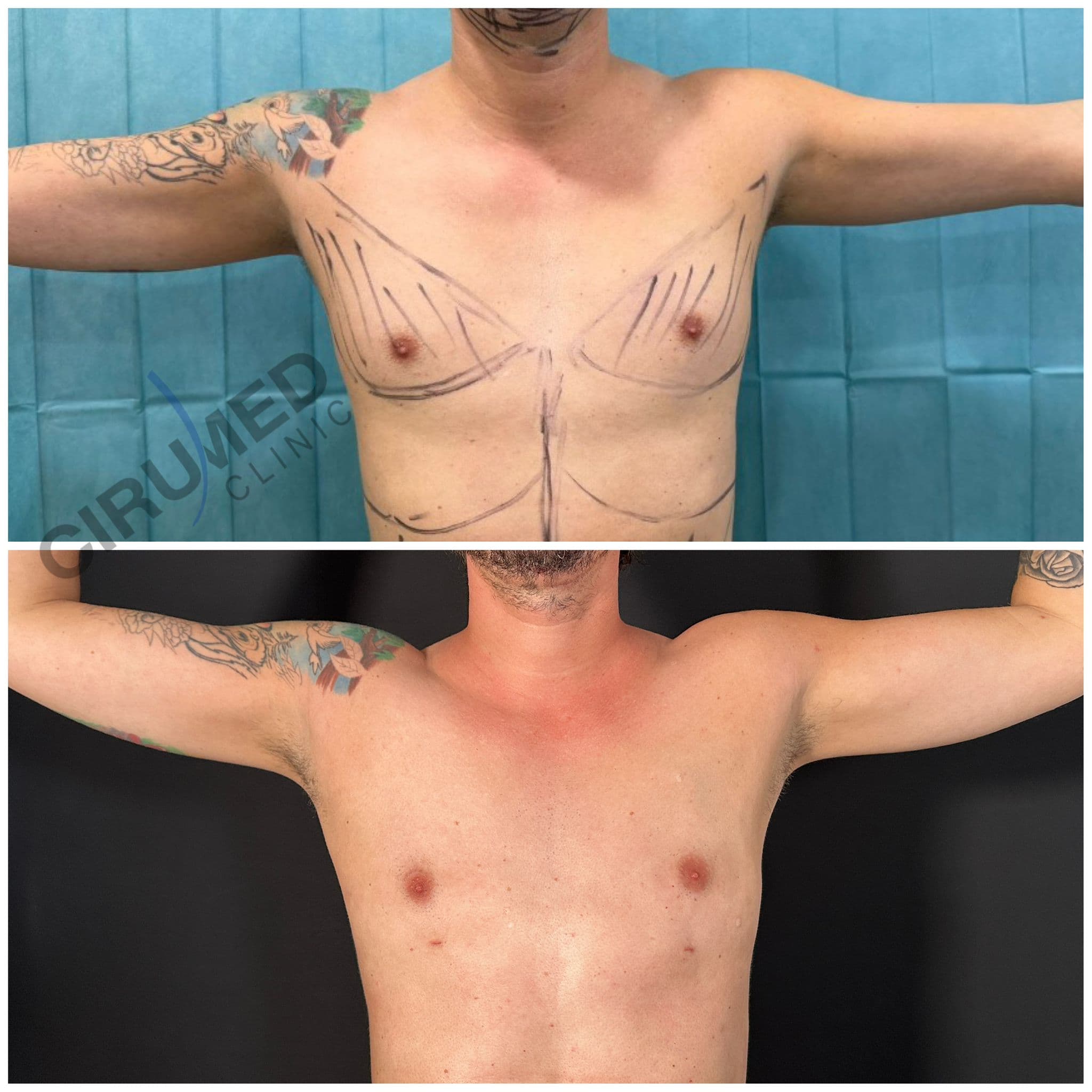 Corrección de ginecomastia masculina con técnica mínimamente invasiva y liposucción masculina