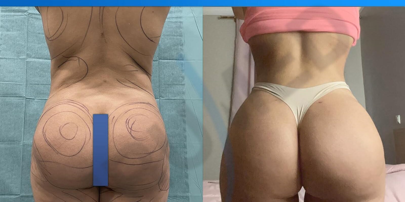 Revision BBL case implants and corrective fat transfer
