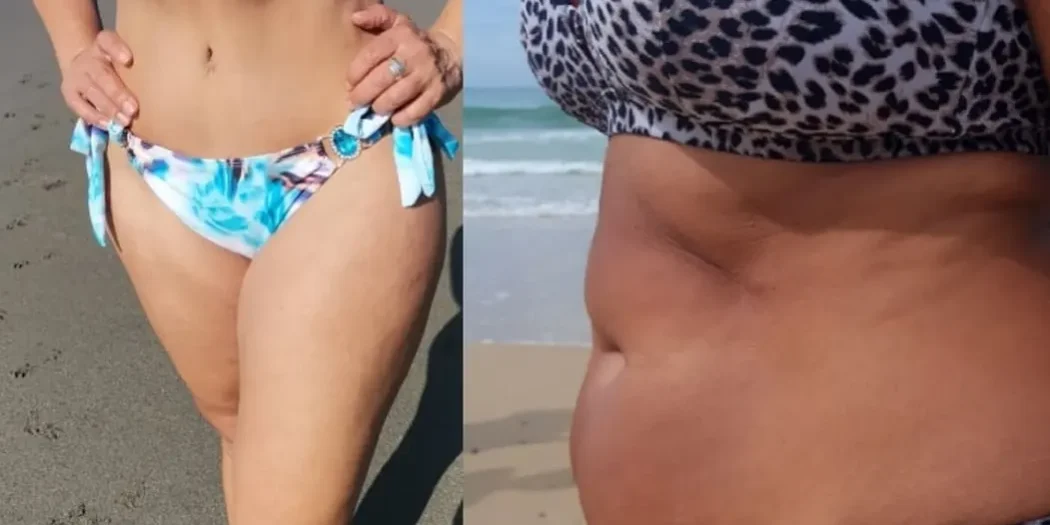 mommy makeover tummy tuck